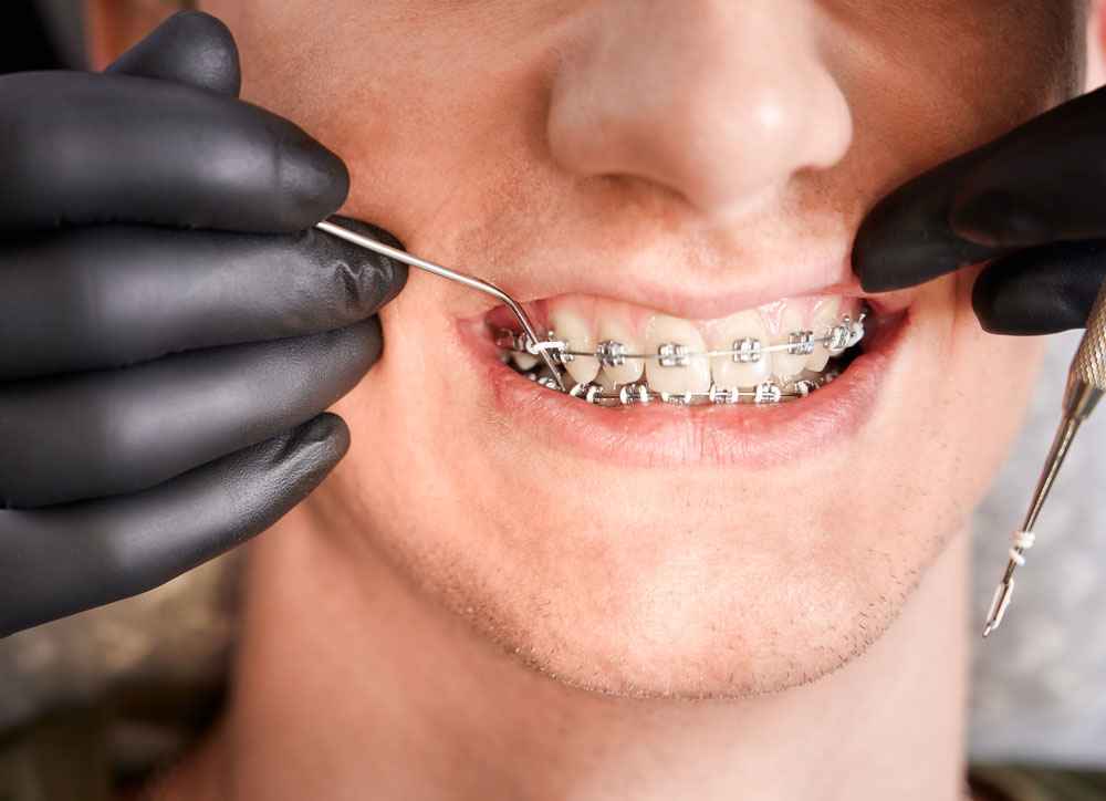 Cómo manejar de manera cómoda los alambres de ortodoncia - Generación  Dental Clinic